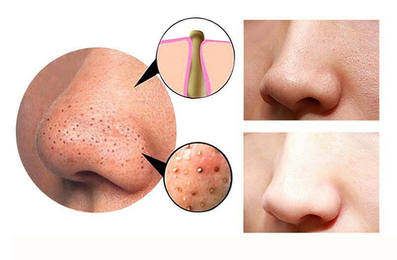 4 in 1 Body Guasha Cupping Blackhead Remover Machine Facial Pore Deep Cleansing Beauty Skin Care.